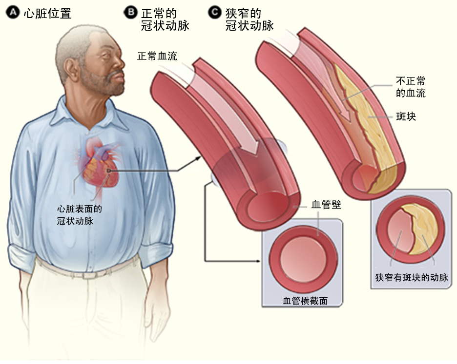 什麽是冠心病?