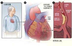 冠心病的起因是什麽国产看真人毛片爱做A片?
