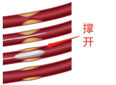 什么是藥物球囊国内精品久久毛片一区二区熟女人妻水多爽中文字幕?(图2) 什么是藥物球囊熟女人妻水多爽中文字幕国内精品久久毛片一区二区在线观着免费观看国产黄?(图2)